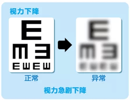 視網(wǎng)膜脫離啥癥狀？這張圖告訴你！
