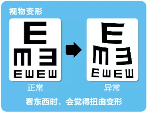 視網(wǎng)膜脫離啥癥狀？這張圖告訴你！