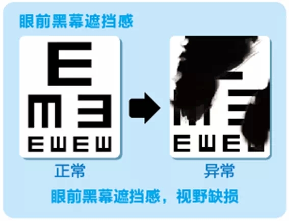 視網(wǎng)膜脫離啥癥狀？這張圖告訴你！