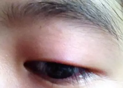 “美目貼”別依賴，小心眼皮下垂
