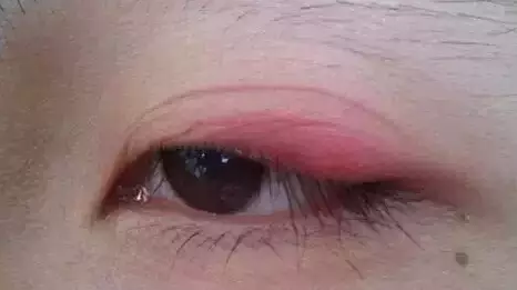 “美目貼”別依賴，小心眼皮下垂