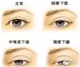 “美目貼”別依賴，小心眼皮下垂