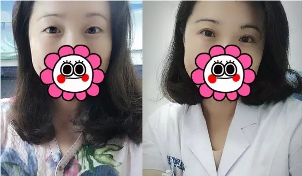 要不要做雙眼皮？別糾結(jié)了看這個！