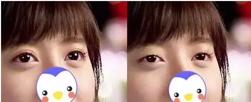 要不要做雙眼皮？別糾結(jié)了看這個！