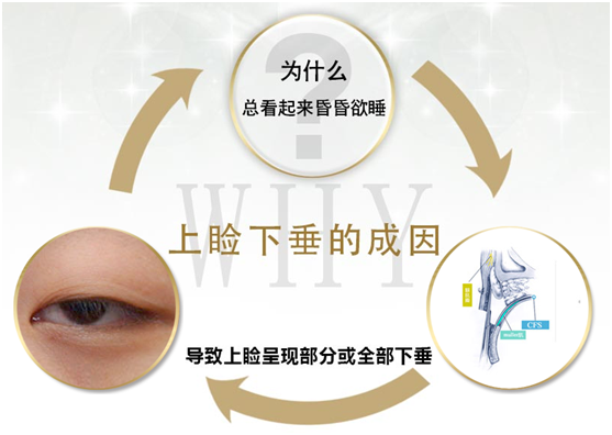 拯救惺忪睡眼，告別上瞼下垂！