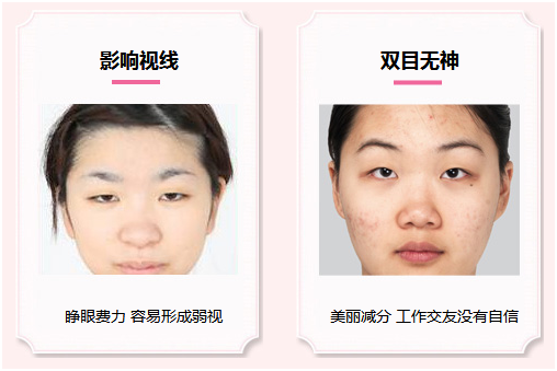 拯救惺忪睡眼，告別上瞼下垂！