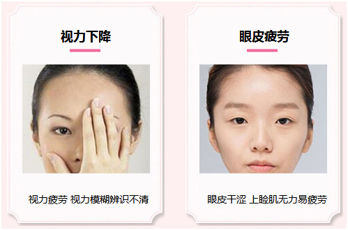 拯救惺忪睡眼，告別上瞼下垂！