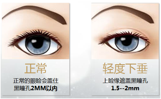拯救惺忪睡眼，告別上瞼下垂！