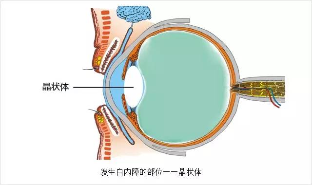 眼科主任告誡白內(nèi)障這幾大誤區(qū)，80%的老人上當(dāng)