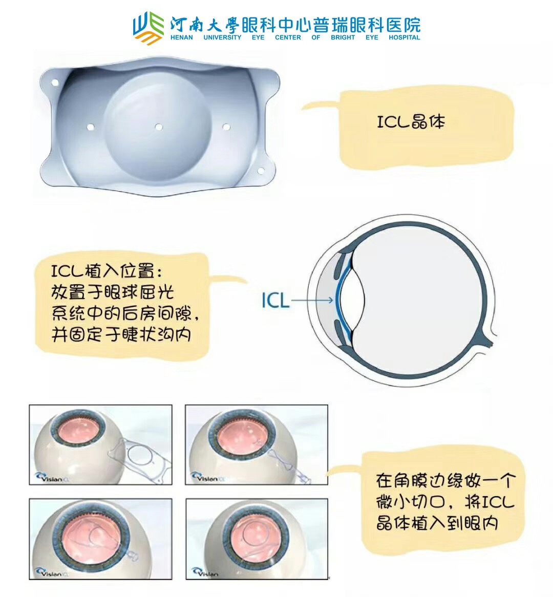 近視度數(shù)太高，還能做手術(shù)嗎？