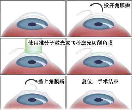 如果眼睛近視了該怎么？