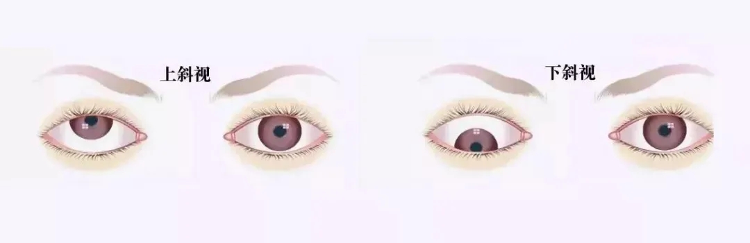 關(guān)于斜視，這幾個(gè)誤區(qū)害人不淺!
