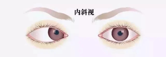 關(guān)于斜視，這幾個(gè)誤區(qū)害人不淺!