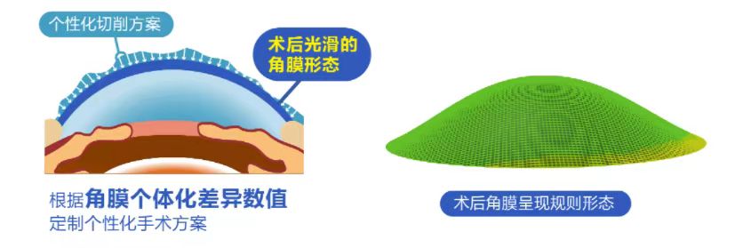 微雕優(yōu)視飛秒，重新定義角膜屈光手術(shù)，讓視力多看一行！