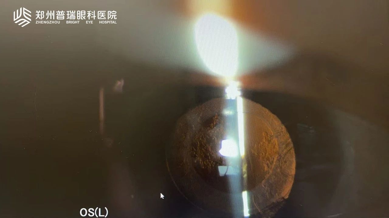 白內(nèi)障術(shù)后視力又下降？6大原因多方面解析！